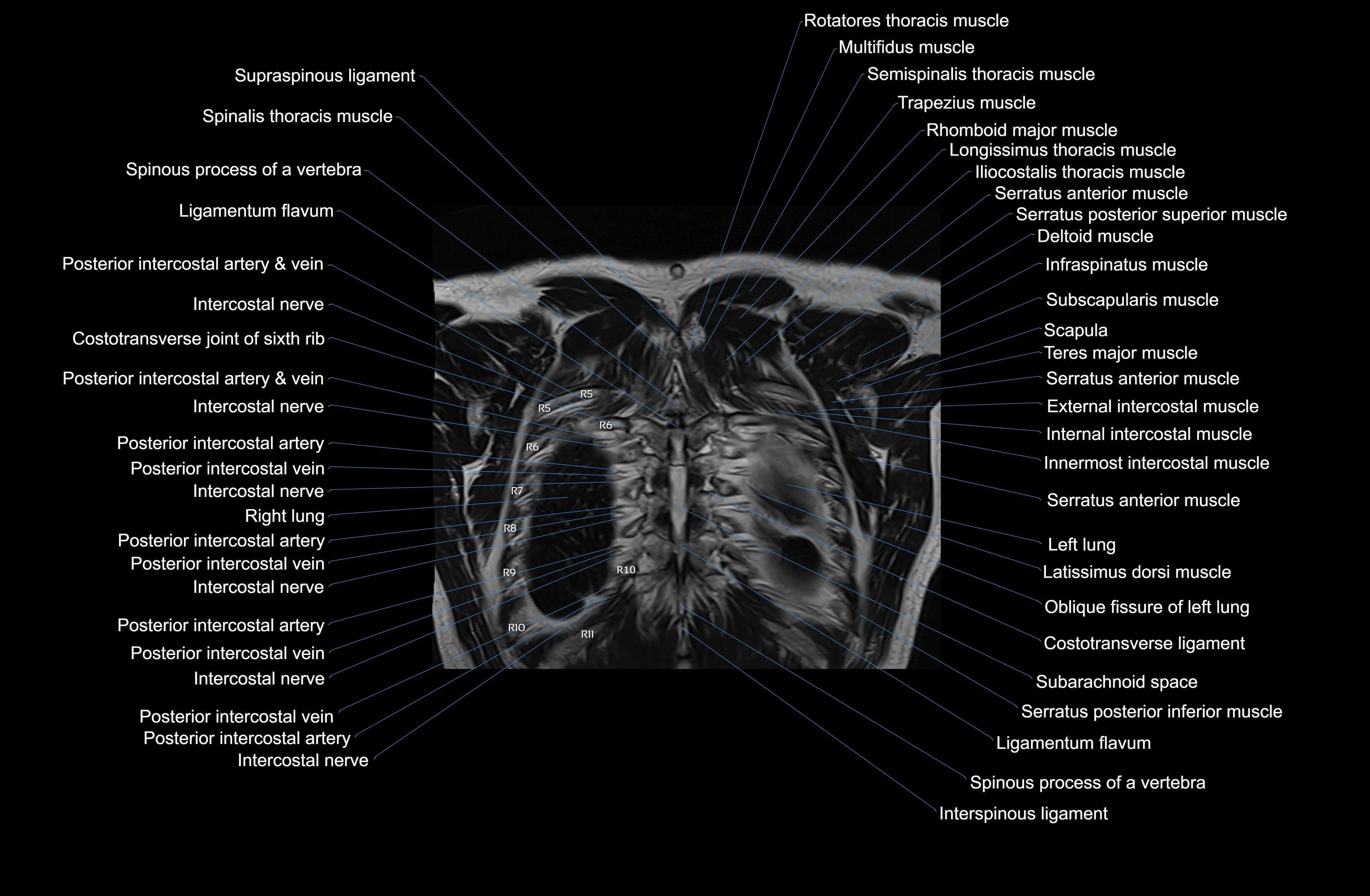 MRI chest (thorax) coronal  cross sectional anatomy 3T radiology  image-img-00001-00038.webp